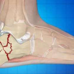Перелом пяточной кости со смещением степень тяжести
