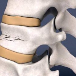 Компрессионный перелом позвоночника грудного отдела лечение дома