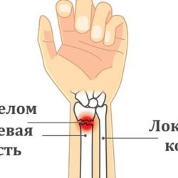 Техника наложения гипса при переломе лучевой кости