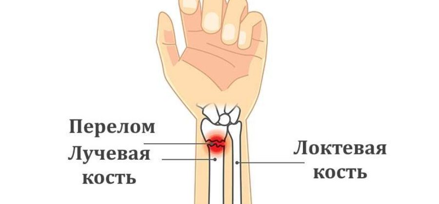 Техника наложения гипса при переломе лучевой кости