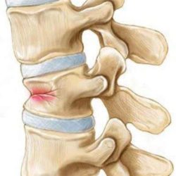 Компрессионный перелом позвоночника последствия грудного отдела позвоночника