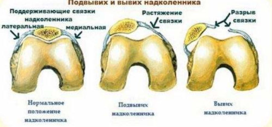 Привычный вывих надколенника у ребенка 13 лет