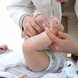 Методы лечения врожденного вывиха бедра на первом году жизни ребенка