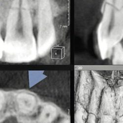 Перелом в средней части корня зуба сопровождается