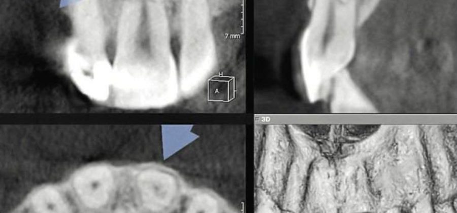Перелом в средней части корня зуба сопровождается