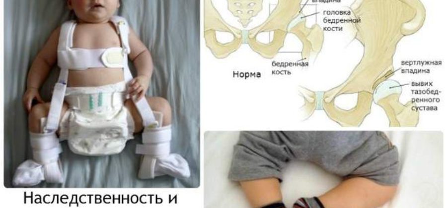 Лечение врожденного вывиха тазобедренного сустава у детей