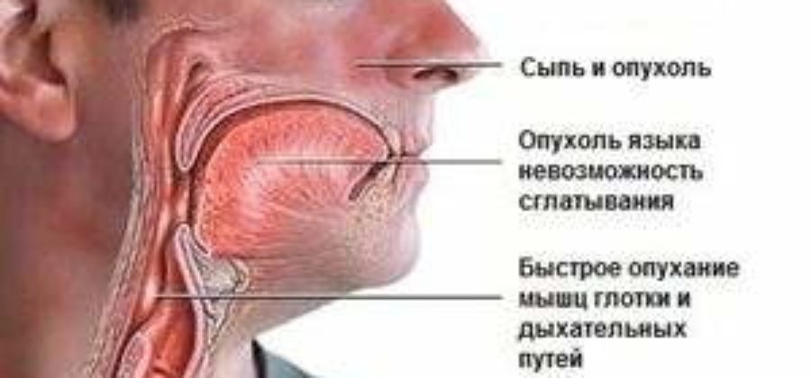 Отек квинке причины клиническая картина диагностика и неотложная помощь