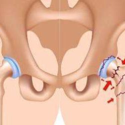 Тазобедренный сустав перелом лечение в домашних условиях