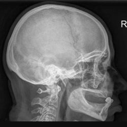 Перелом костей основания черепа как правило происходит при