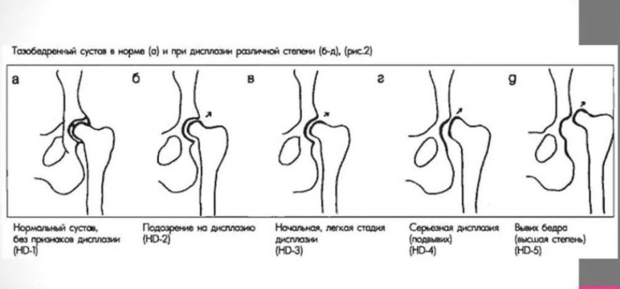 Схема врожденного вывиха бедра