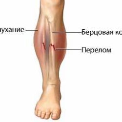 Перелом нижней трети диафиза правой большеберцовой кости