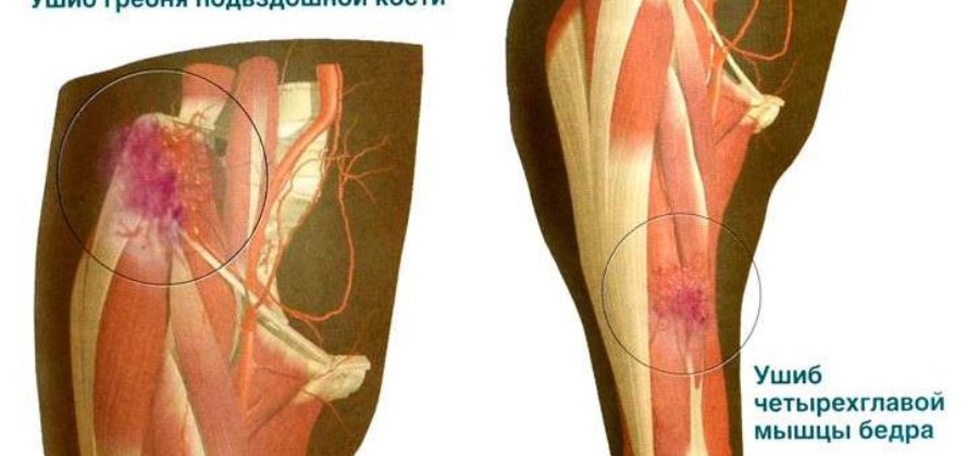 Перечислите действия которые необходимо совершить при ушибе бедра