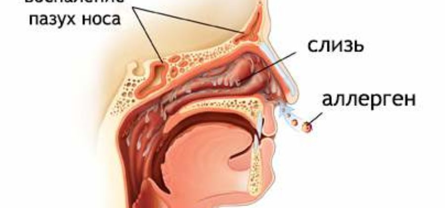 Причины отека слизистой носа и затрудненного дыхания