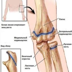 Перелом в зоне роста у ребенка локтя