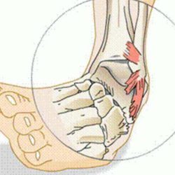 Боли в голеностопе при ходьбе после перелома