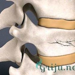 Как лечат компрессионный перелом позвоночника в европе?