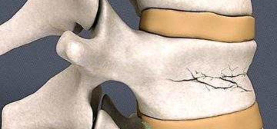 Как лечат компрессионный перелом позвоночника в европе?