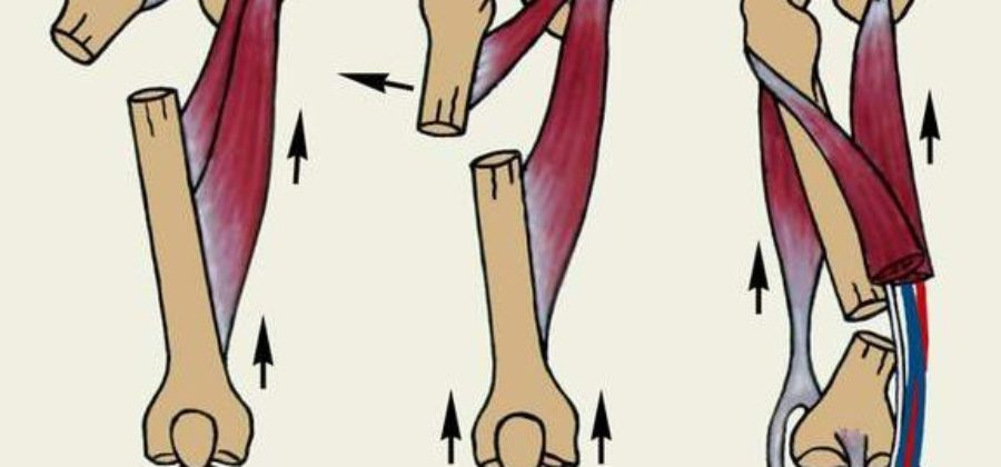 Травма правого бедра. Диафизарный перелом бедра симптомы. Клиновидный перелом бедренной кости. Перелом бедренной кости реабилитация.