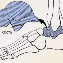 Перелом таранной кости сколько ходить в гипсе