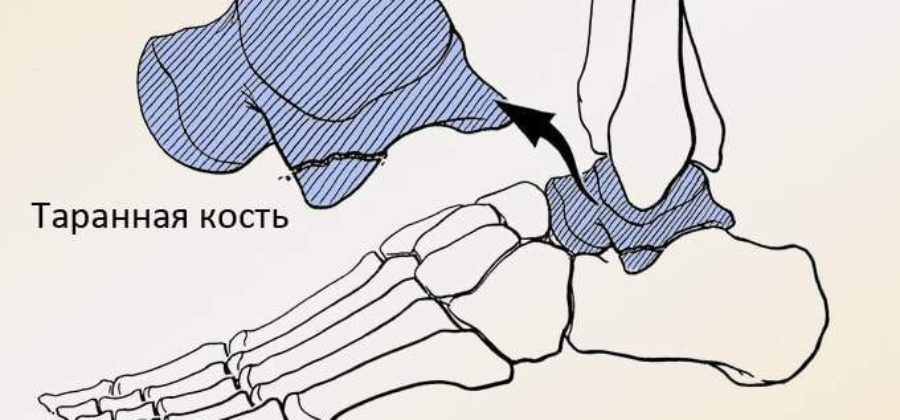 Перелом таранной кости сколько ходить в гипсе