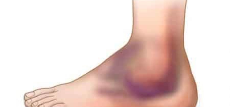 Иммобилизация нижней конечности при переломе голеностопного сустава