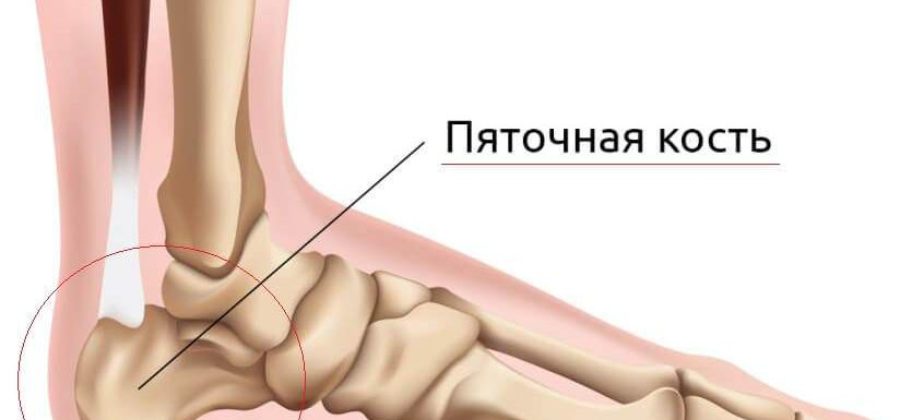 Какие признаки перелома или трещины на пятки?