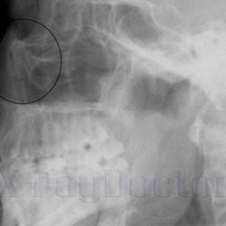 Перелом костей носа рентгенограммы в боковой проекции