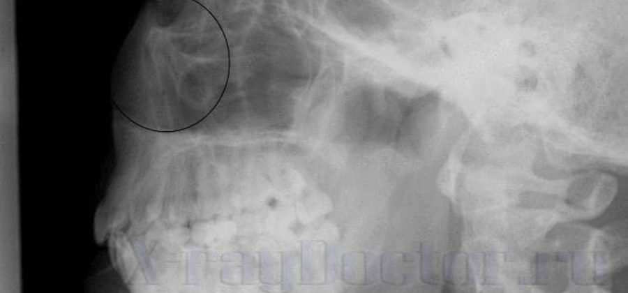 Перелом костей носа рентгенограммы в боковой проекции