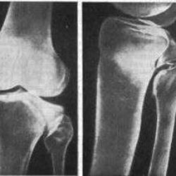 Перелом межмыщелкового возвышения большеберцовой кости сроки лечения