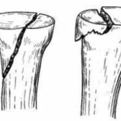 Перелом головки локтевого сустава без смещения лечение