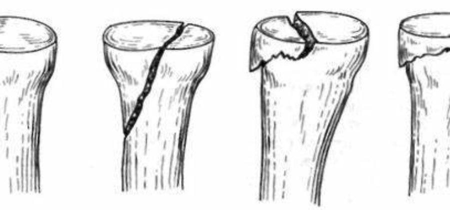 Перелом головки локтевого сустава без смещения лечение