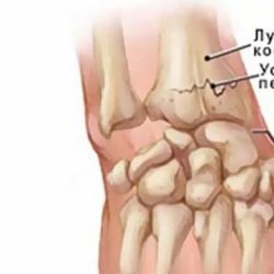 Что хуже закрытый перелом или открытый перелом?