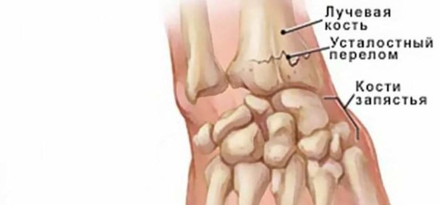 Что хуже закрытый перелом или открытый перелом?