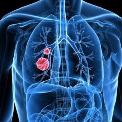 Дифференциальная диагностика сердечной астмы и отека легких