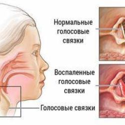 Отек гортани симптомы и лечение у взрослых