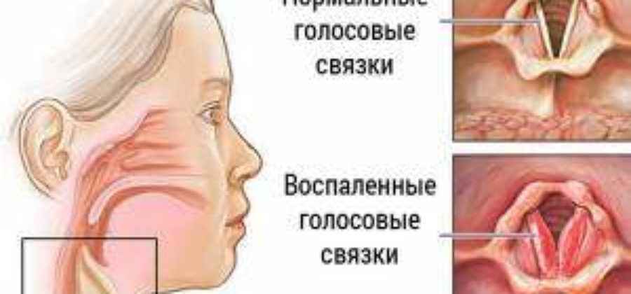 Отек гортани симптомы и лечение у взрослых