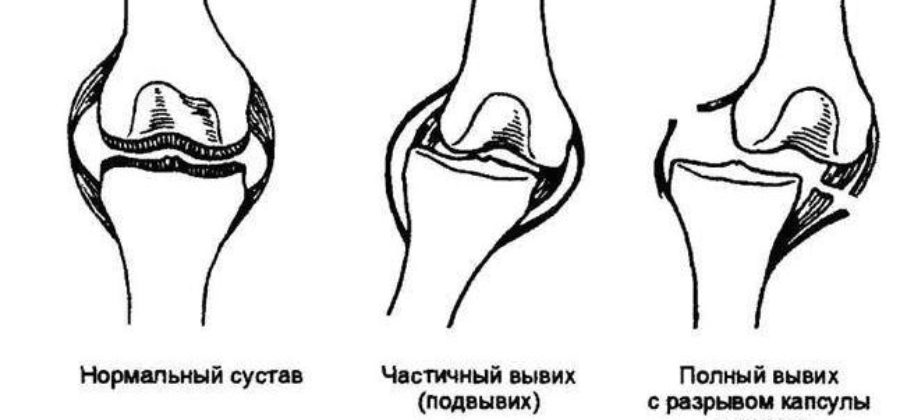 Вывих это стойкое смещение суставных концов костей