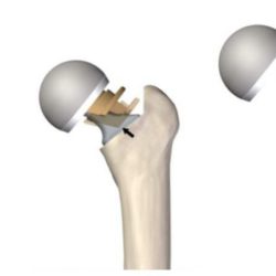 Гемиартропластика тазобедренного сустава при переломе шейки бедра