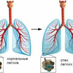 Неотложная помощь при отеке легких алгоритм действий медсестры