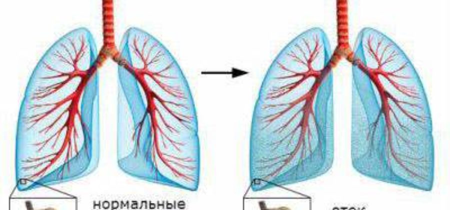 Неотложная помощь при отеке легких алгоритм действий медсестры