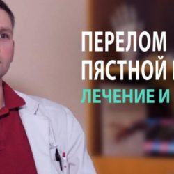 Перелом диафиза 5 пястной кости со смещением