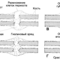 Что делать если перелом руки не срастается?