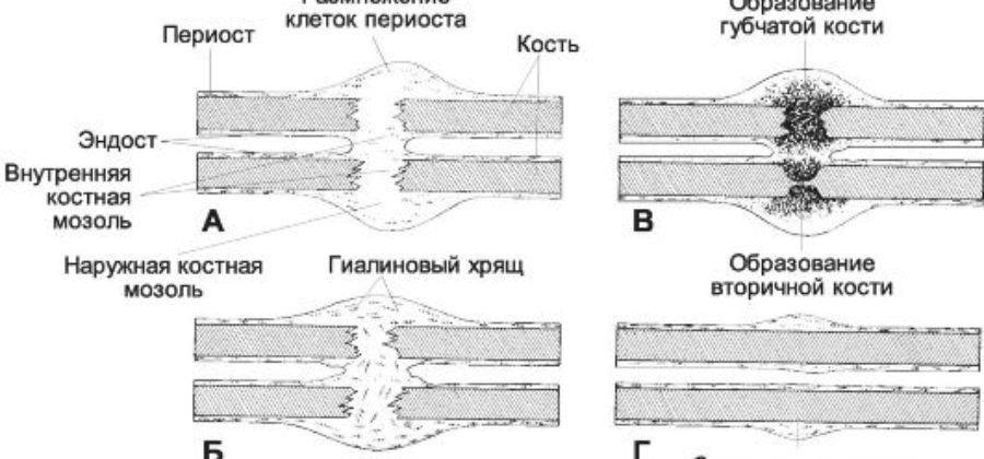 Что делать если перелом руки не срастается?