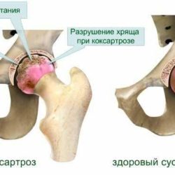 У бабушки отек ноги выше колена с внутренней стороны