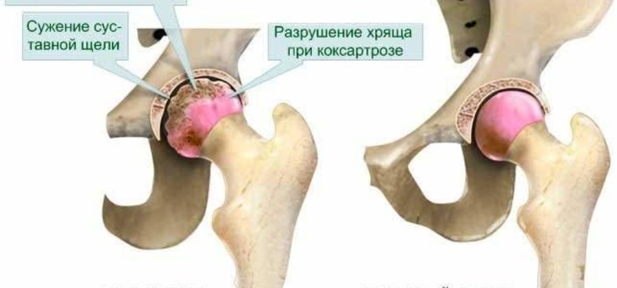 У бабушки отек ноги выше колена с внутренней стороны