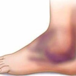 Как лечить вывих ноги в области ступни?