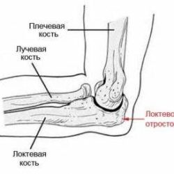 Оскольчатый перелом локтевой кости со смещением операция