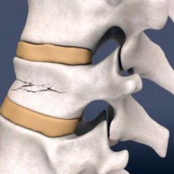 Сколько стоит операция на позвоночник при переломе