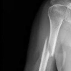 Перелом плечевой кости руки лечение срок срастания