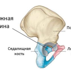 Перелом дна вертлужной впадины со смещением отломков